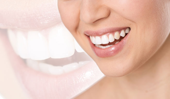 Comment realiser un blanchement dentaire chez soi ?